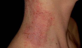 Lokális kezelési stratégiák a gyermekkori atópiás dermatitis kezelésében